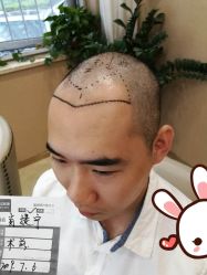 点击看大图 -大麦微针植发丨全国连锁