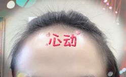 -大麦微针植发全国连锁