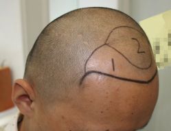 -大麦微针植发丨全国连锁