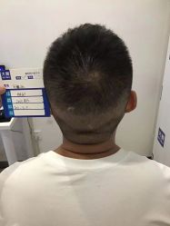 点击看大图 -大麦微针植发丨全国连锁