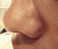 -成都苗方清颜专业祛痘