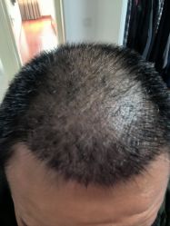 点击看大图 体验后-大麦微针植发丨全国连锁