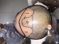 -大麦微针植发丨全国连锁