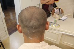 点击看大图 -大麦微针植发丨全国连锁