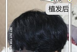 -大麦微针植发全国连锁