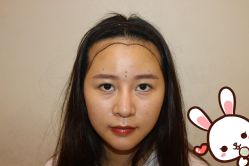 点击看大图 -大麦微针植发丨全国连锁