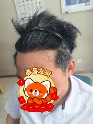 -大麦微针植发丨全国连锁