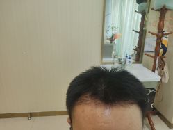 -碧莲盛·不剃发植发