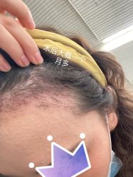 体验后-熙朵美学植发连锁