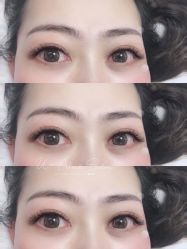 -U-Nail