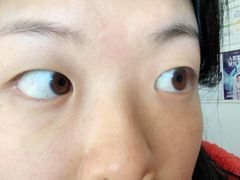 -黑马眼科·近视手术