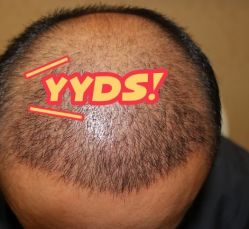 -大麦微针植发丨全国连锁