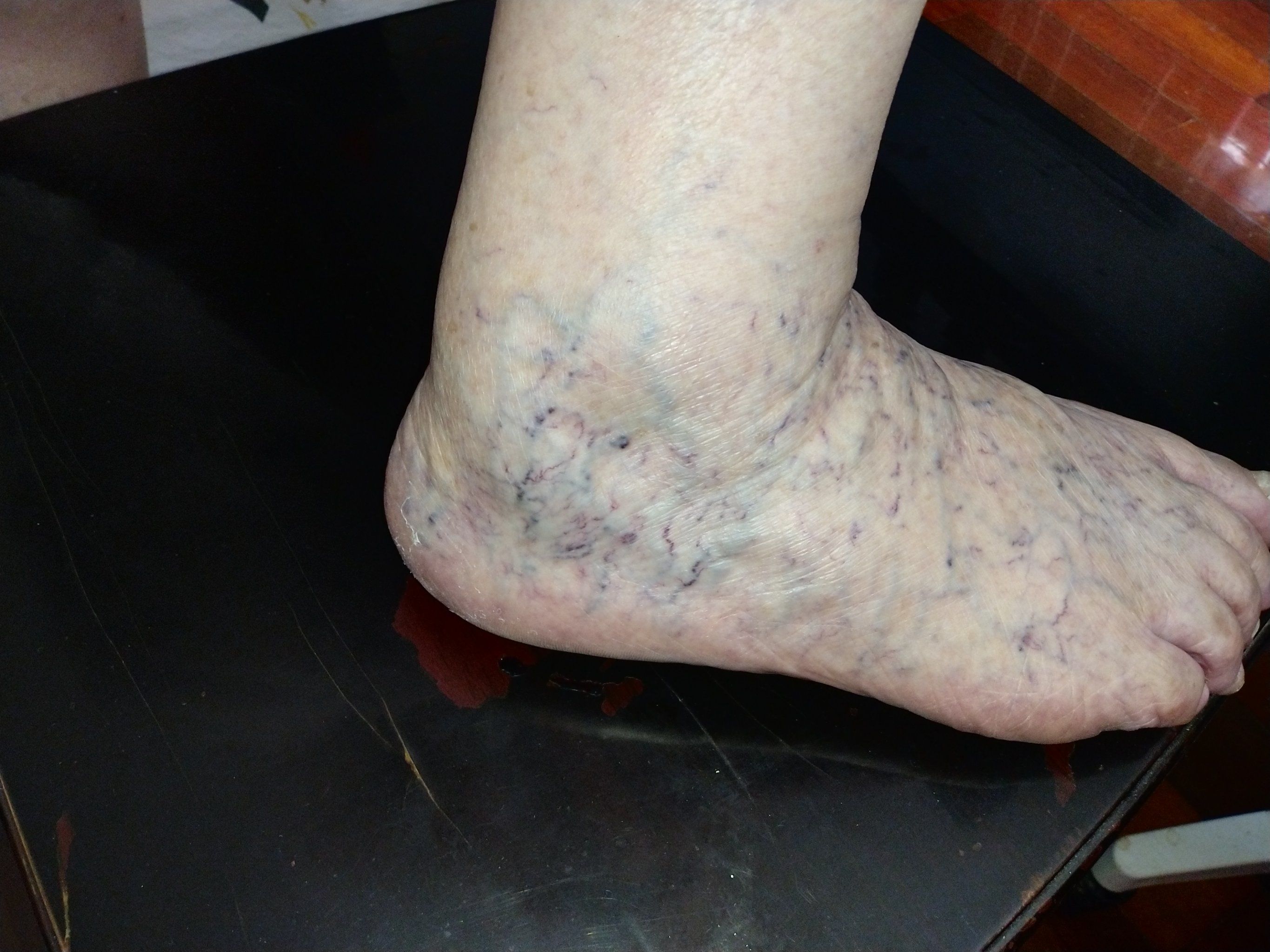 看看这些静脉曲张照片