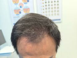 -大麦微针植发全国连锁
