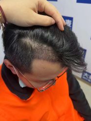 体验后-大麦微针植发丨全国连锁