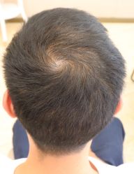 -大麦微针植发全国连锁