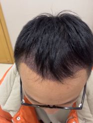 点击看大图 -大麦微针植发丨全国连锁