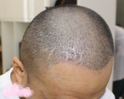 -大麦微针植发丨全国连锁