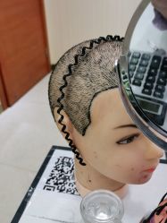 点击看大图 -碧莲盛·不剃发植发