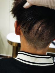 -碧莲盛·不剃发植发