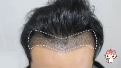 -大麦微针植发丨全国连锁