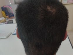 点击看大图 -碧莲盛·不剃发植发
