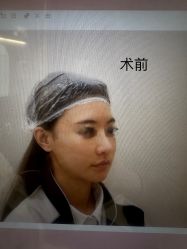 体验前-杭州米兰柏羽医疗美容医院