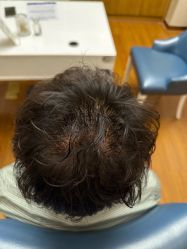 -大麦微针植发全国连锁