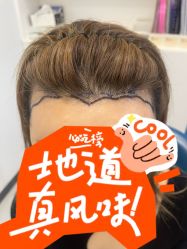 体验前-大麦微针植发全国连锁