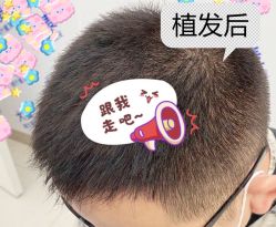 -大麦微针植发全国连锁