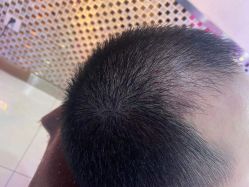 体验后-大麦微针植发全国连锁