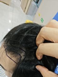 -碧莲盛不剃发植发