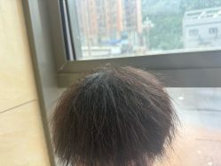 -碧莲盛·不剃发植发