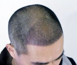 -大麦微针植发丨全国连锁