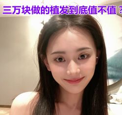 -碧莲盛·不剃发植发