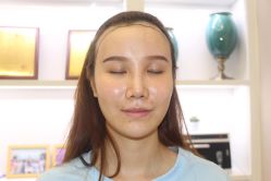 点击看大图 -大麦微针植发丨全国连锁