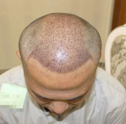 -大麦微针植发丨全国连锁