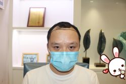 -大麦微针植发丨全国连锁