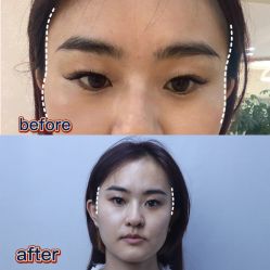 体验后-紫洁俪方（北京）医疗美容