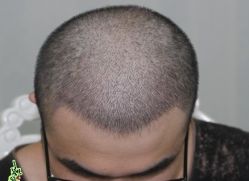 -大麦微针植发丨全国连锁