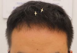 -大麦微针植发全国连锁