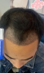 -大麦微针植发丨全国连锁