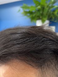 -大麦微针植发全国连锁