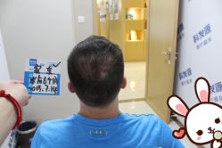 -大麦微针植发丨全国连锁