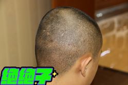 -大麦微针植发全国连锁