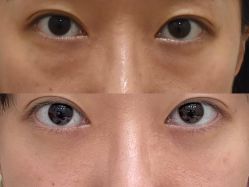-广州健丽·去眼袋医疗美容机构