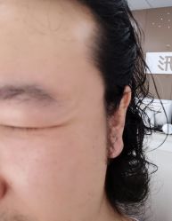 体验后-东剑医学美容·注射美学中心