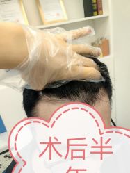 -大麦微针植发全国连锁