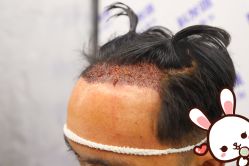 -大麦微针植发丨全国连锁