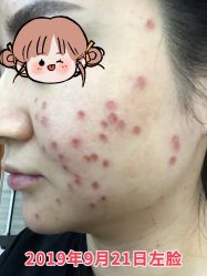 -美丽人生祛斑扁平疣汗管瘤中心